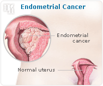 Endometrial cancer