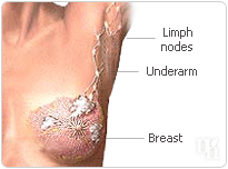 Breast cancer is associated with HRT