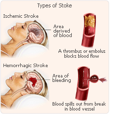 hrt stroke