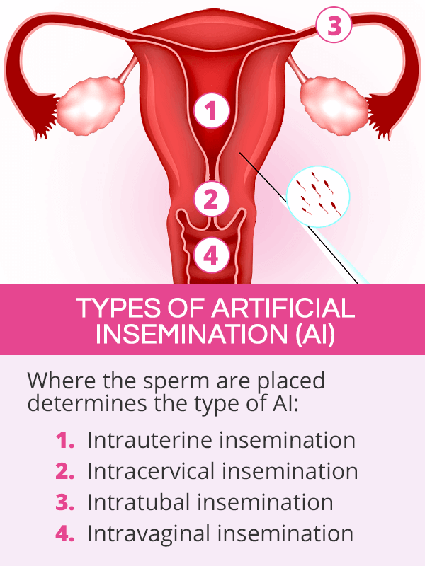 Types of artificial insemination
