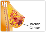 HRT increase the risk of breast cancer.