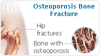 osteoporosis bone structure