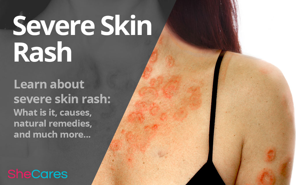 Severe Skin Rash