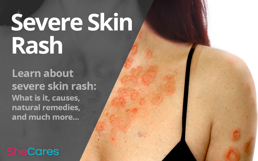 Severe Skin Rash | Shecares