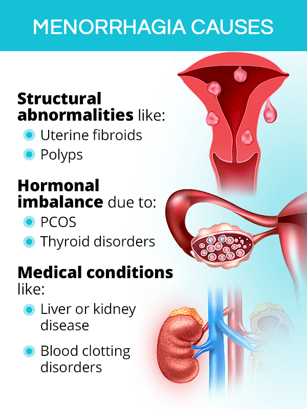 Menorrhagia causes