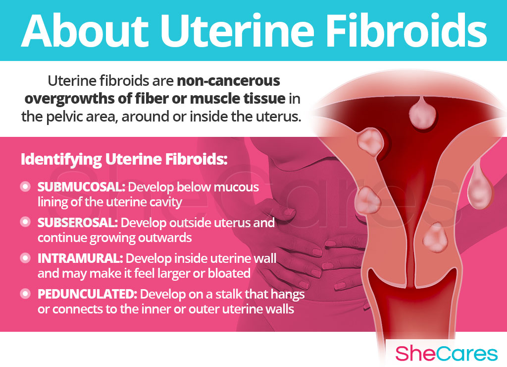About Uterine Fibroids