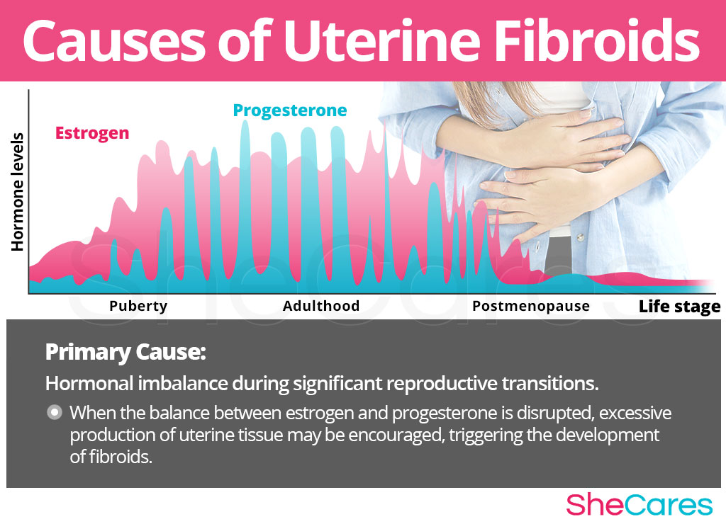 Causes of  Uterine Fibroids