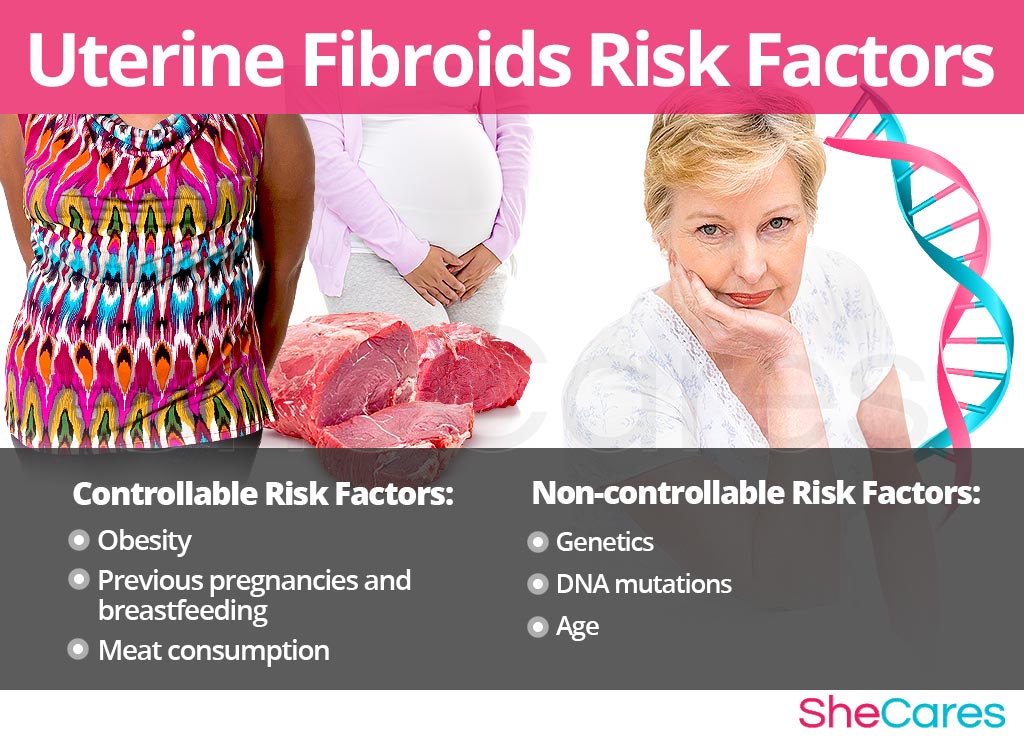 Uterine Fibroids - Risk Factors and Triggers