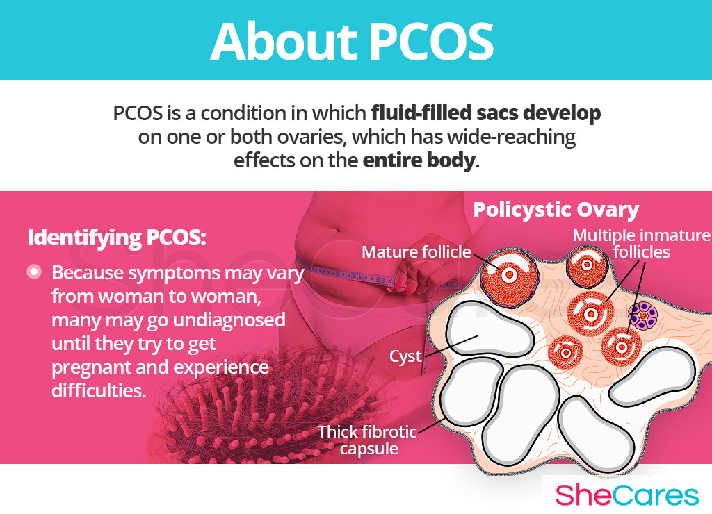 About PCOS