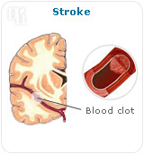 Stroke