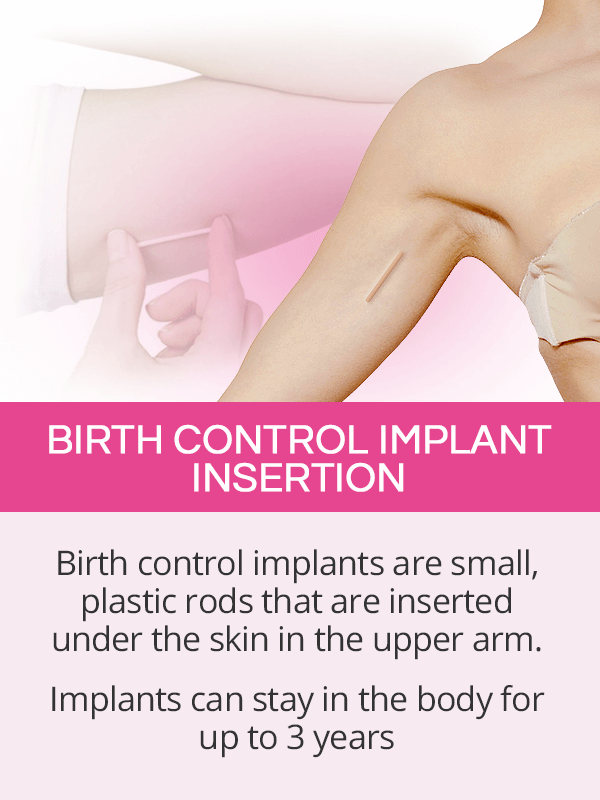 Birth control implant insertion