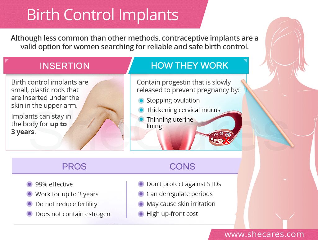 Birth Control Implants