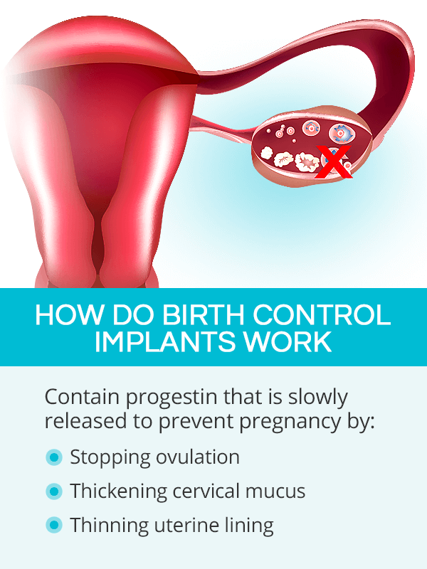 How do birth control implants work?