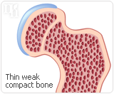 Bone density