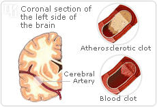 High estrogen levels can lead to strokes.