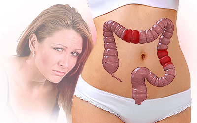 Irritable Bowel Syndrome FAQs