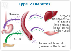 Type II diabetes