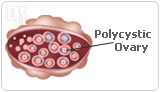 Between 5% and 10% of menstruating women have PCOS