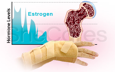 Estrogen and Osteoporosis: A Direct Relation
