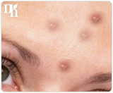 A common cause of acne in adult women is hormonal imbalance