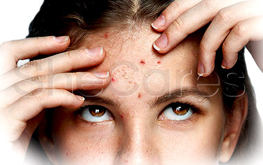 Progesterone Treatment for Acne