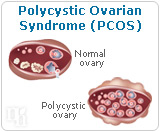 Polycystic ovarian syndrome