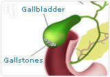 There are additional risks of HRT, like gallbladder disease