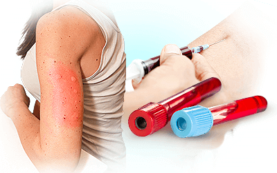 Allergy Blood Test FAQs