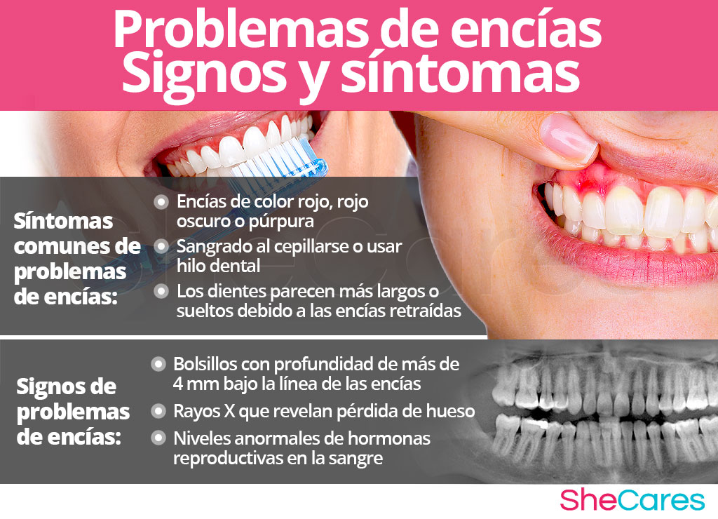 Signos y síntomas de problemas de encías