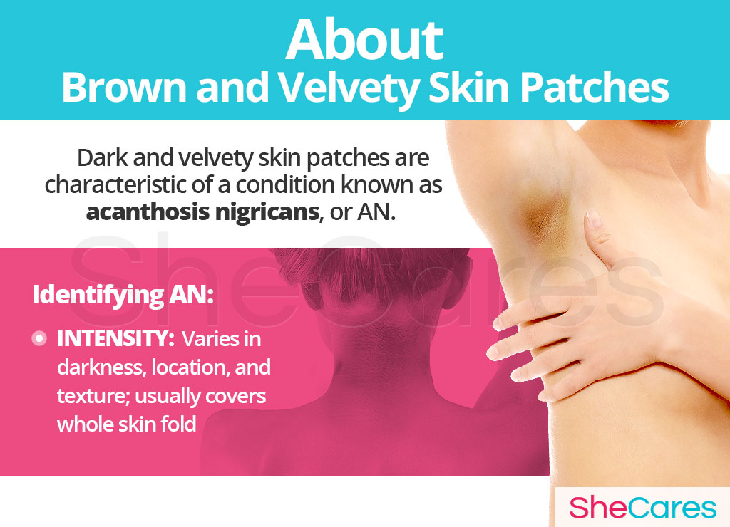 About Brown and Velvety Skin Patches