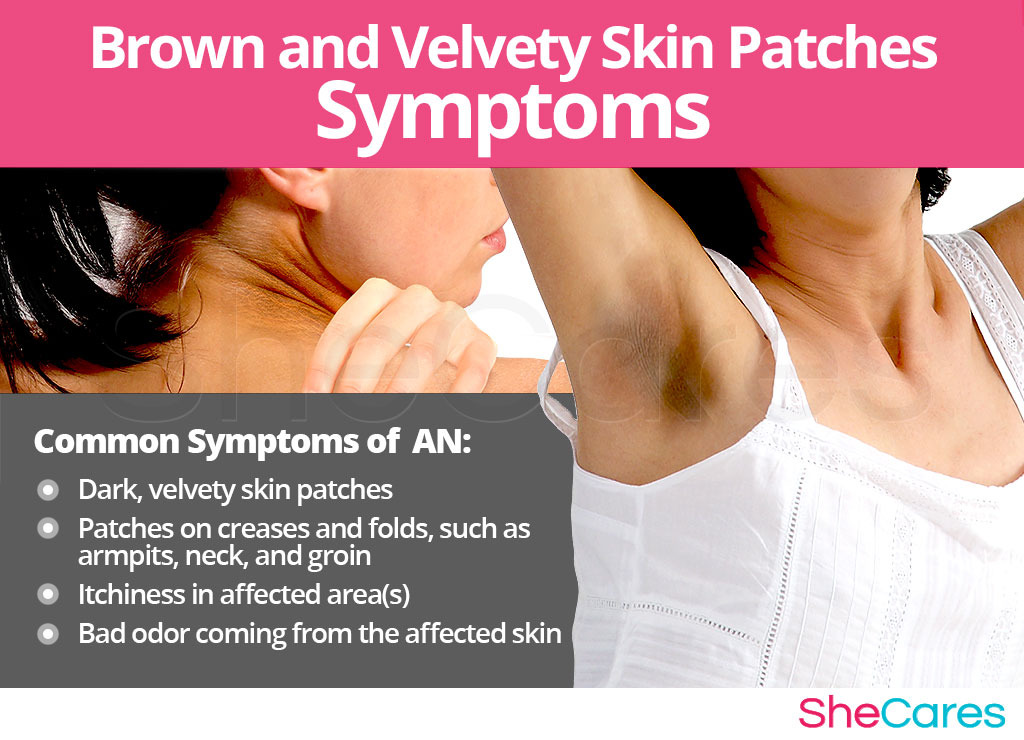 Brown and Velvety Skin Patches - Signs and Symptoms