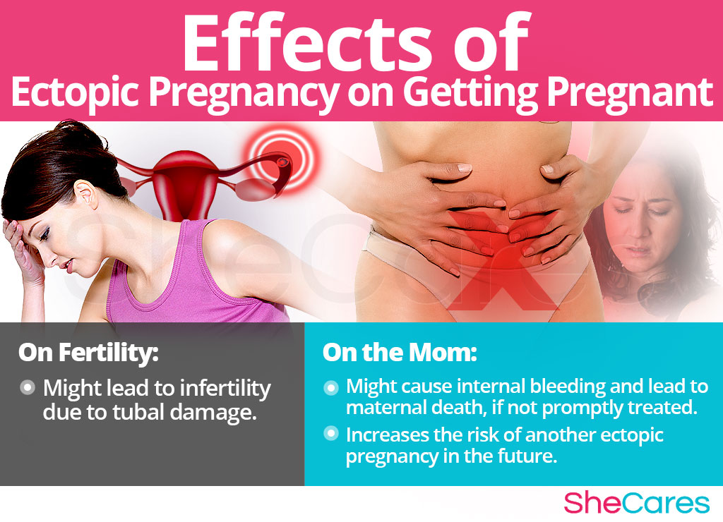 Effects of Ectopic Pregnancy on Getting Pregnancy