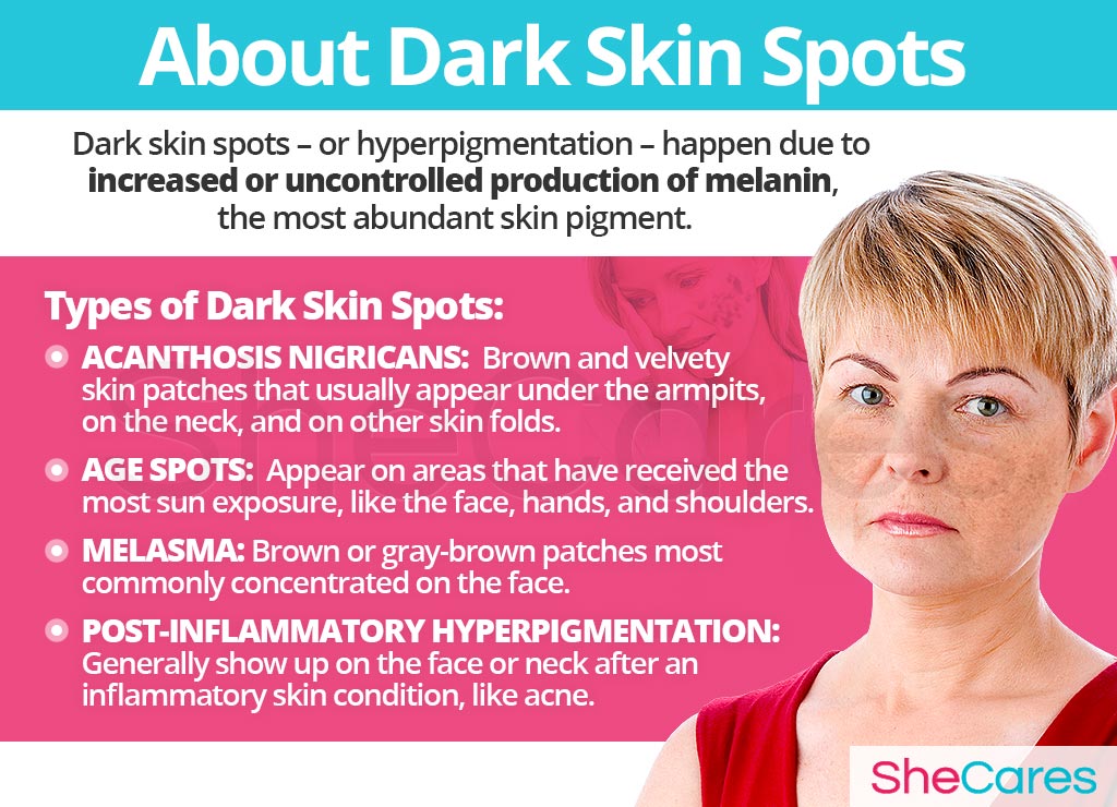 About Dark Skin Spots