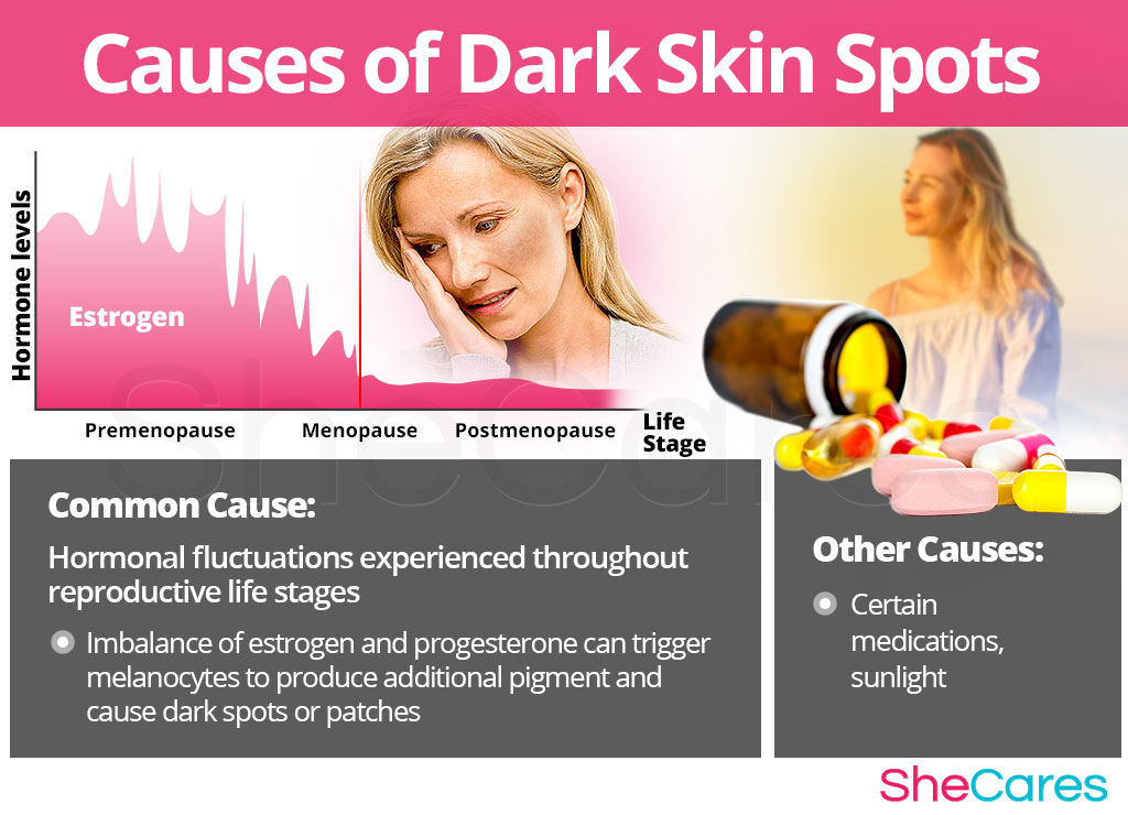 Causes of Dark Skin Spots