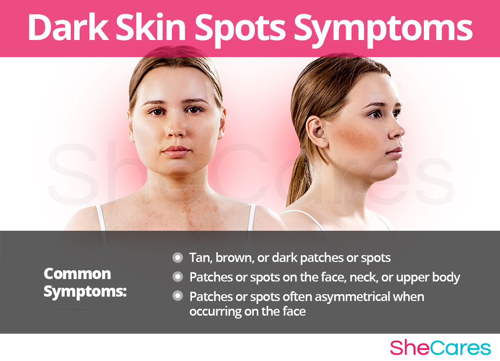 Dark Skin Spots Symptoms