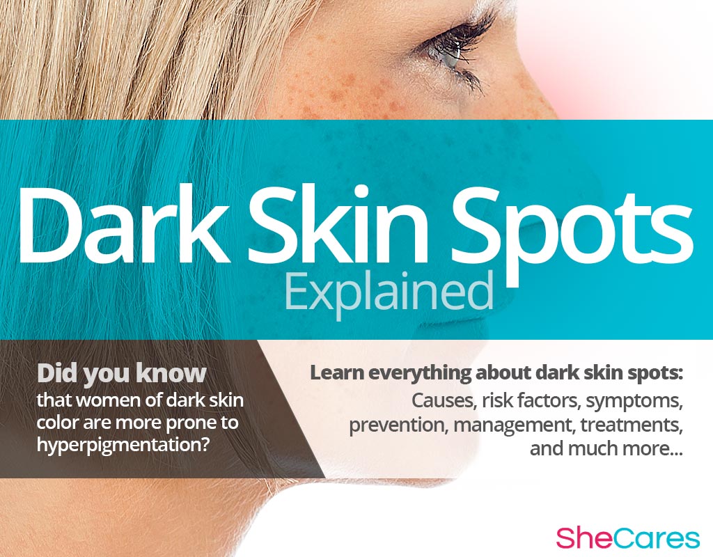 Dark Skin Spots