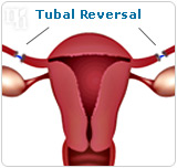 Tubal reversal
