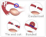 Tubal ligation