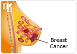 Breast cancer