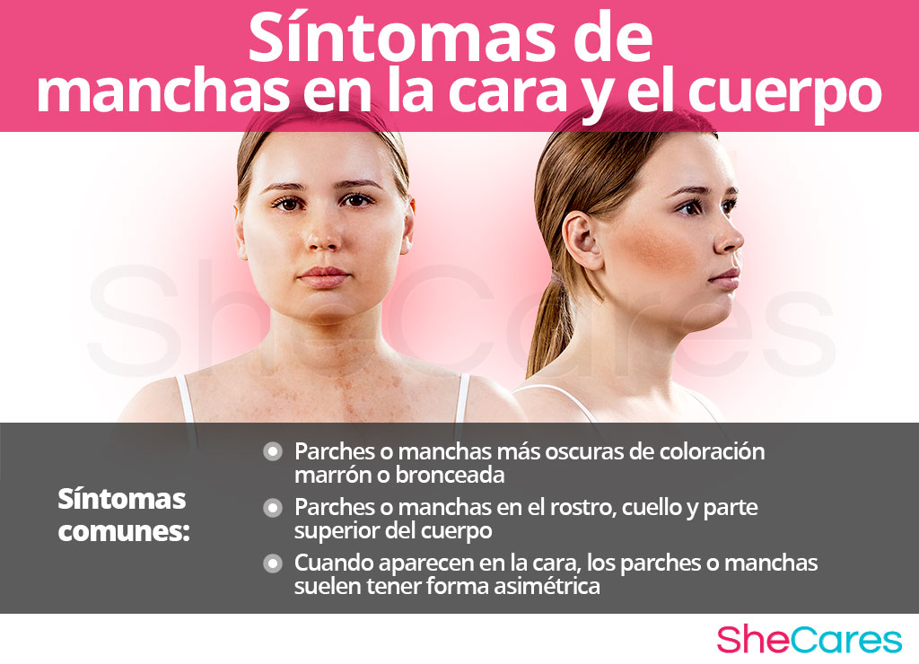 Síntomas de manchas en la cara y el cuerpo