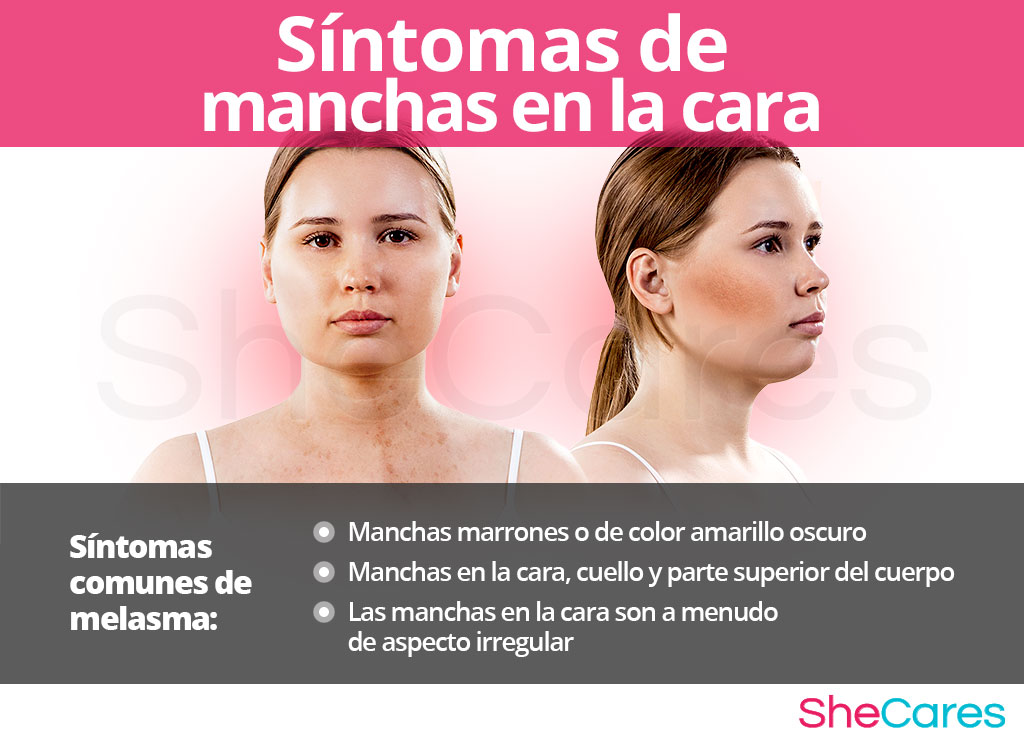 Síntomas de las manchas en la cara