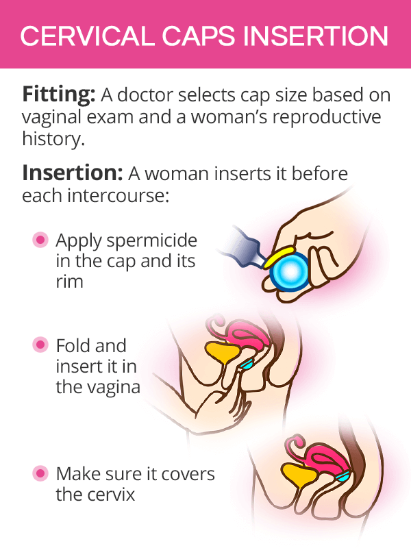 Cervical cap insertion