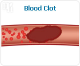 Blood clot