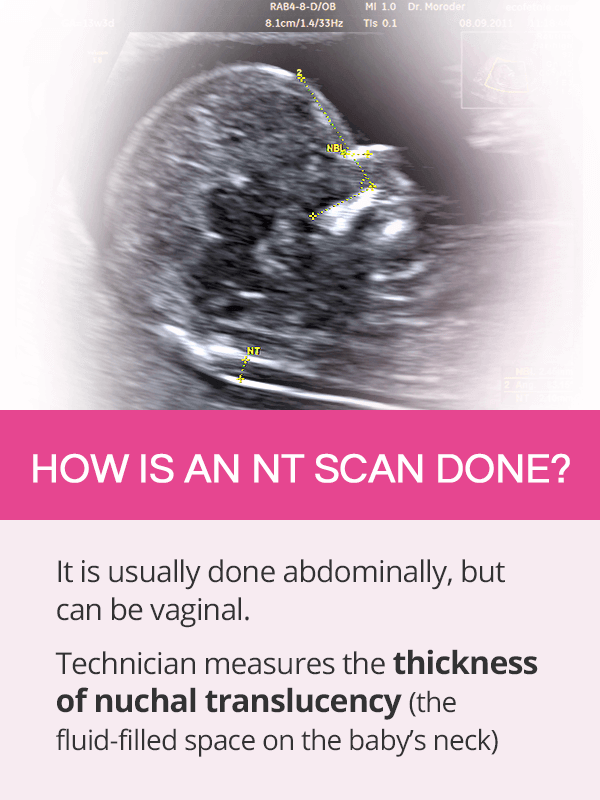 How is a nuchal translucency test done
