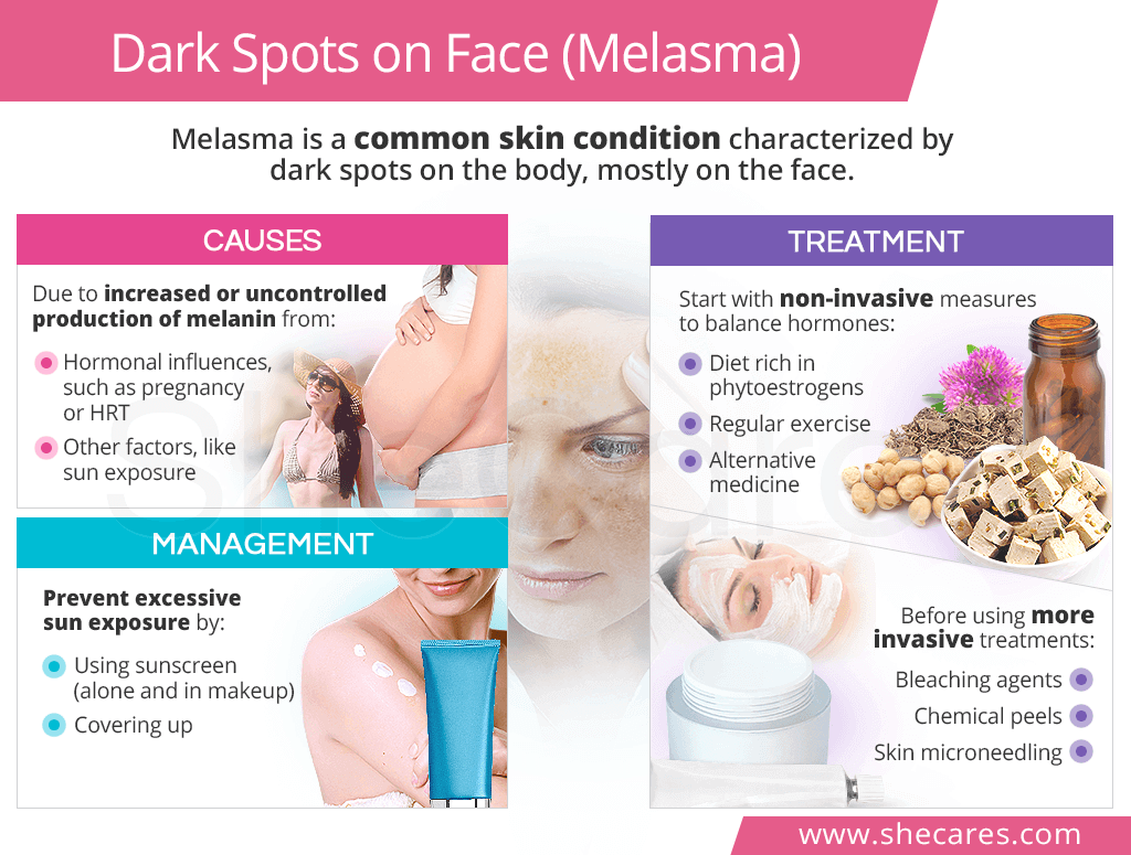 Dark Spots on Face (Melasma)