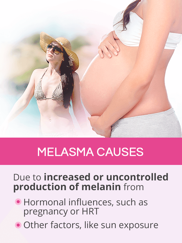 Melasma Causes