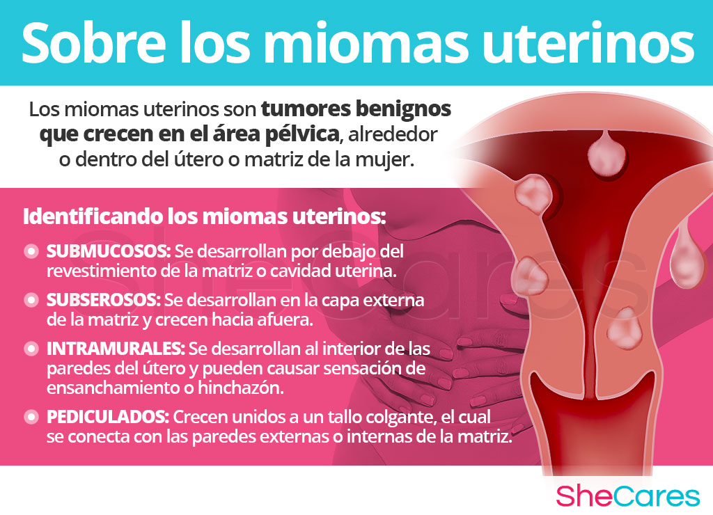 Sobre las miomas uterinos