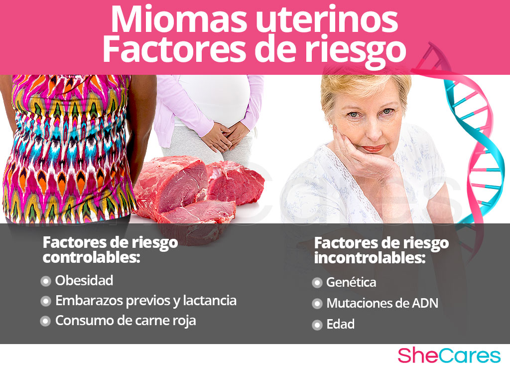 Factores de riesgo para miomas uterinos