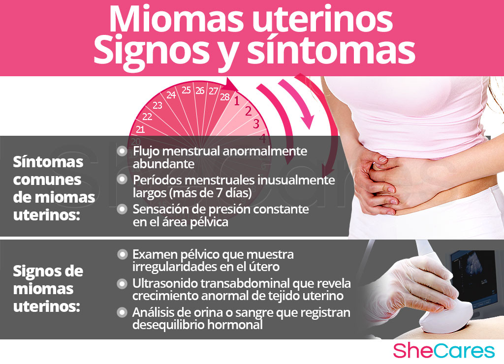 Signos y síntomas de miomas uterinos