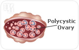 Progesterone and Polycystic Ovary Syndrome